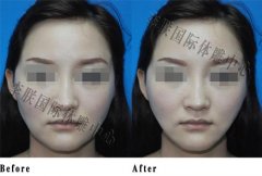 颌部吸脂手术——北京李朕体雕中心