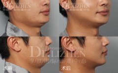 颈部吸脂手术——北京李朕体雕中心